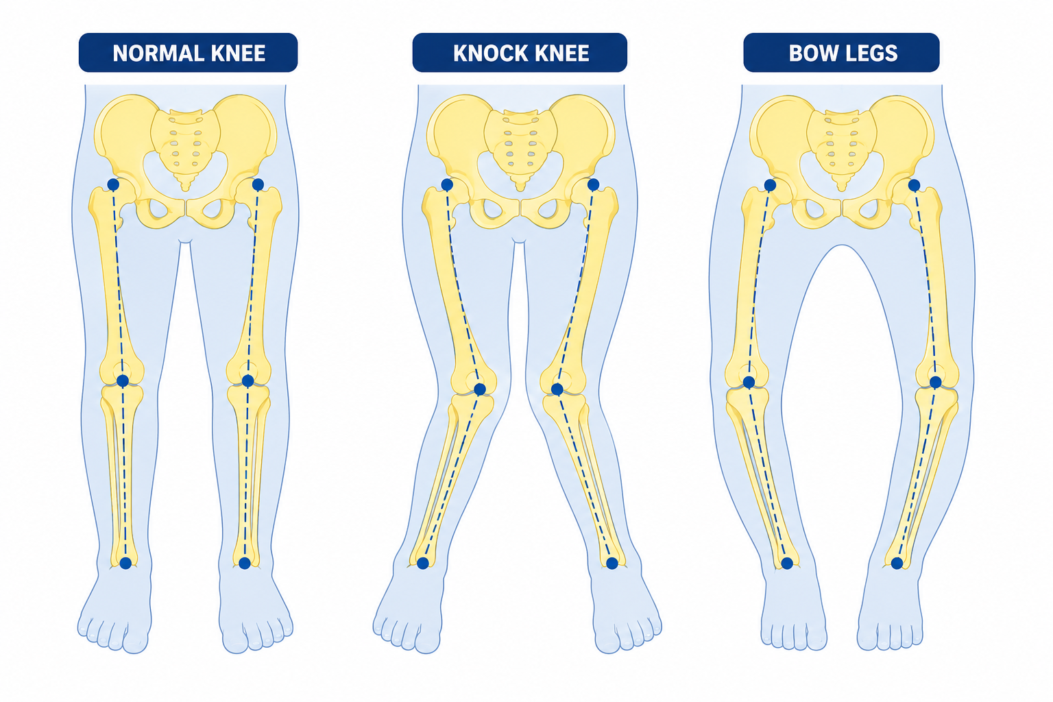 Can Knock Knees Be Corrected Surgically? Understanding Knee Deformities in Growing Teens Can Knock Knees Be Corrected Surgically? Understanding Knee Deformities in Growing Teens