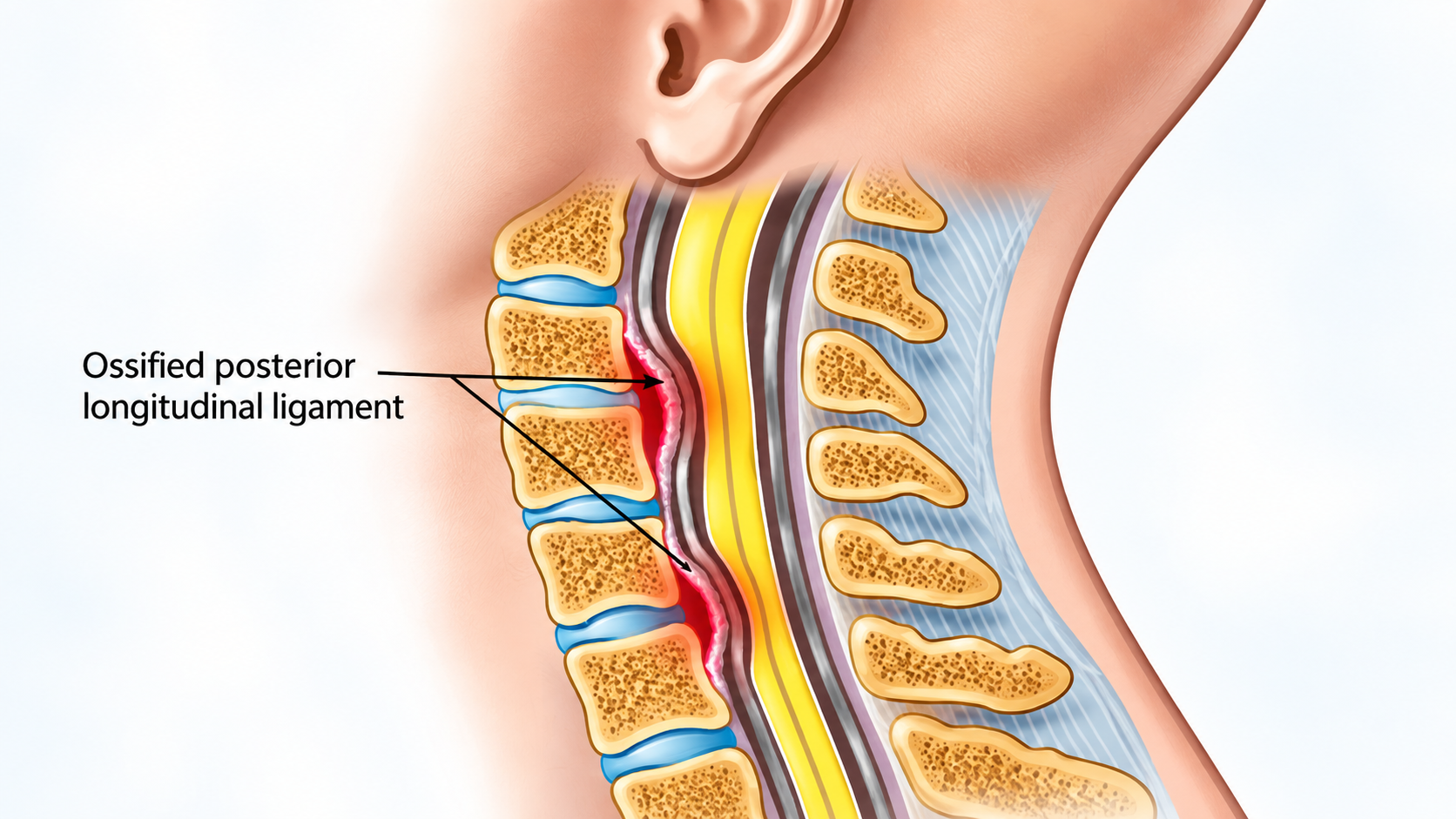 Hospital in Chennai for OPLL: When Calcium Deposits in the Spine Can Compress the Spinal Cord Hospital in Chennai for OPLL: When Calcium Deposits in the Spine Can Compress the Spinal Cord