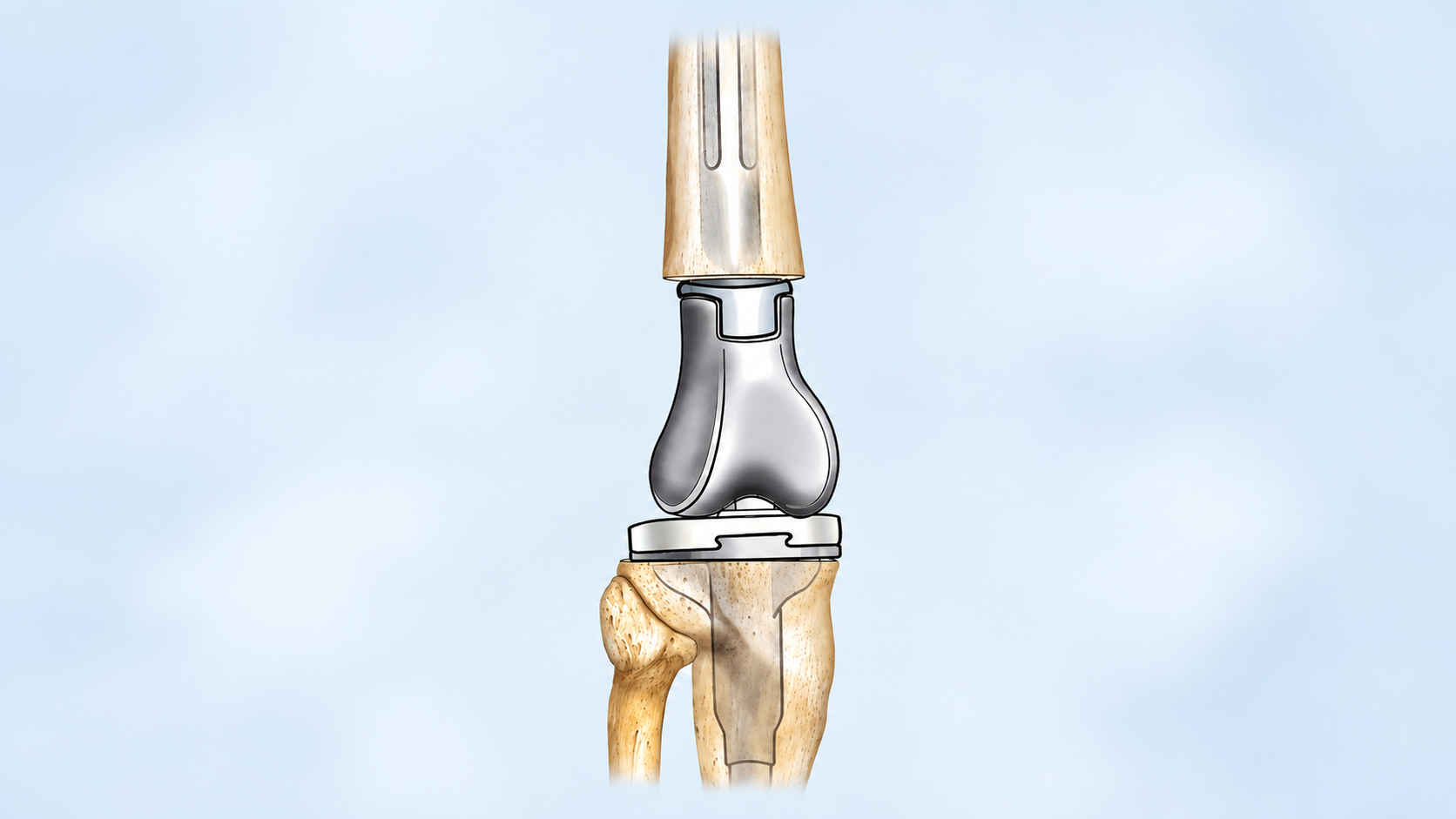 Hospital in Chennai for Knee Arthritis and Diabetes: How to Stay Active Without Worsening Knee Pain Hospital in Chennai for Knee Arthritis and Diabetes: How to Stay Active Without Worsening Knee Pain