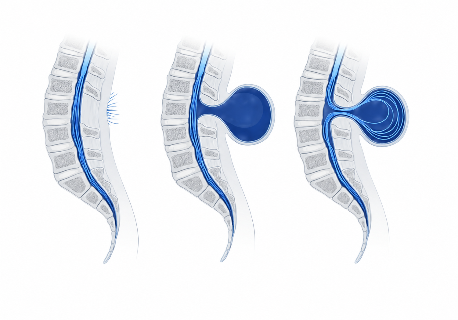 Tethered Cord Syndrome in Children: Early Signs, Diagnosis & Treatment | OLIR Super Speciality Hospital, Chennai Tethered Cord Syndrome in Children: Early Signs, Diagnosis & Treatment | OLIR Super Speciality Hospital, Chennai