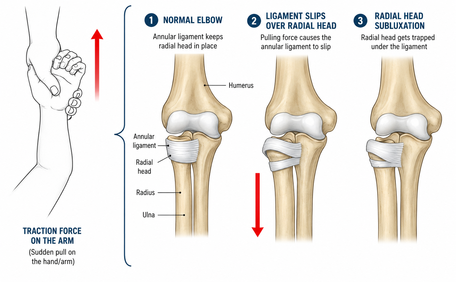 Pulled Elbow (Nursemaid's Elbow) in Children: Causes, Signs & What to Do | OLIR Super Speciality Hospital, Chennai Pulled Elbow (Nursemaid's Elbow) in Children: Causes, Signs & What to Do | OLIR Super Speciality Hospital, Chennai